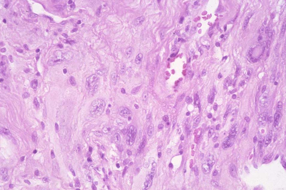 MFH-pleomorphic UCSF collection